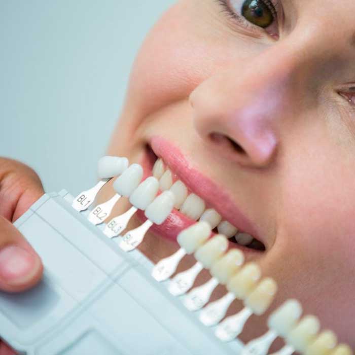 Diseño de sonrisa