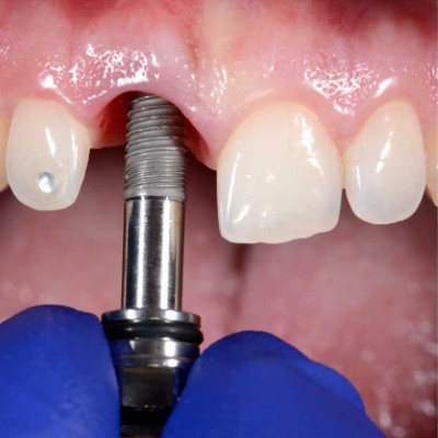 Conoce acerca de los Implantes