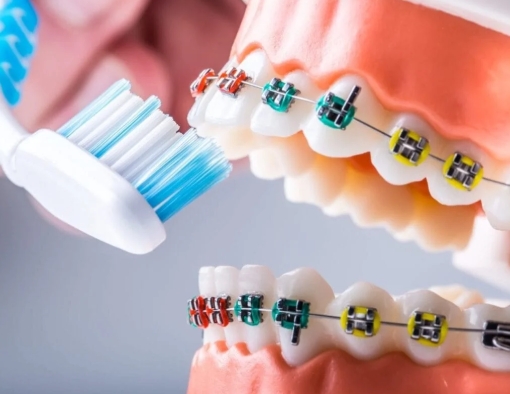 Consecuencias de una Mala Higiene al utilizar Brackets