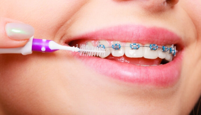 Guía Maestra: Cómo Limpiar tus Dientes con Brackets